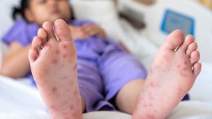 В Киевской области зафиксирована вспышка вируса Коксаки среди детей