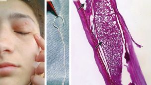 Жінка жила з 11-сантиметровим червом в оці і не підозрювала про це