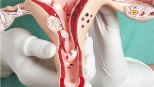 10 ключових факторів ризику раку шийки матки, про які варто знати кожній жінці