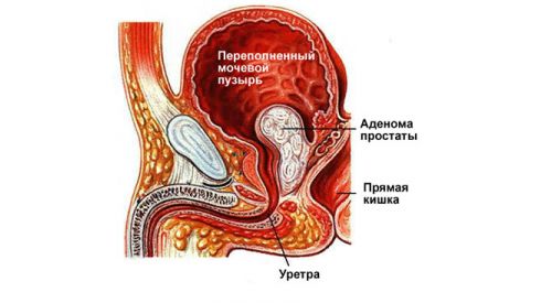К раку простаты может привести витамин Е