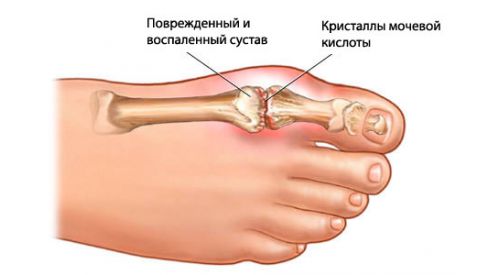 Подагра поможет от слабоумия