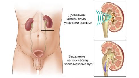 Камни в почках очень опасны