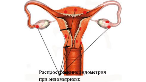 Новая причина эндометриоза