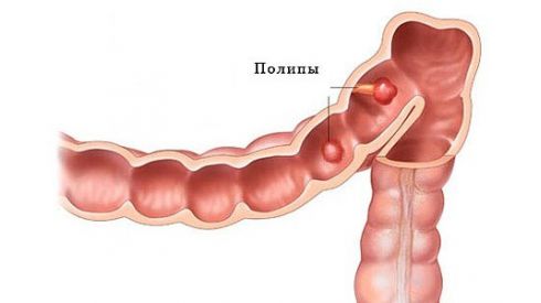Полипы в кишечнике