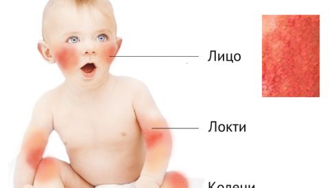 3-7 марта дни защиты от атопического дерматита в Украине