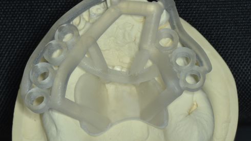 Новый, не травматичный способ установки имплантатов!