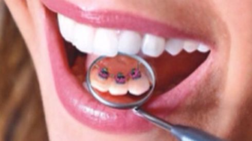 Ортодонтическое лечение лингвальными брекетами