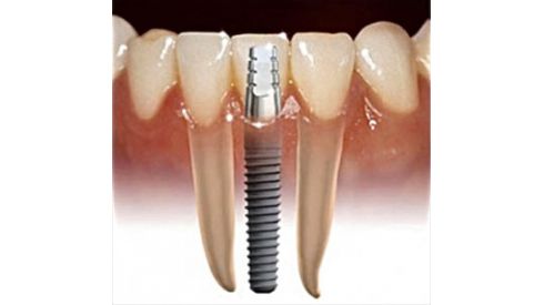 Имплантация зубов