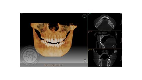 NEW!!! Компьютерная томография челюстно-лицевой области