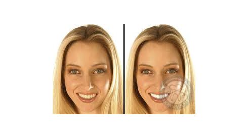 NEW!!! Компьютерное моделирование будущей улыбки — входит в цену лечения!