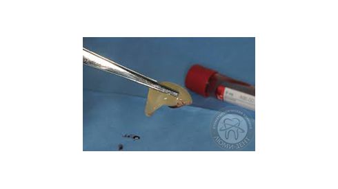 NEW!!! Костная пластика на основе мембран из собственной крови