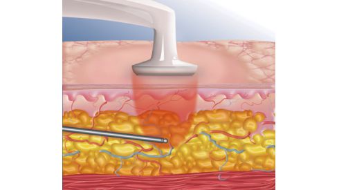 Преимущества и особенности разных типов липосакции
