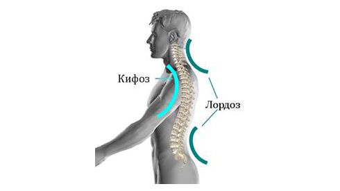 Нарушения осанки