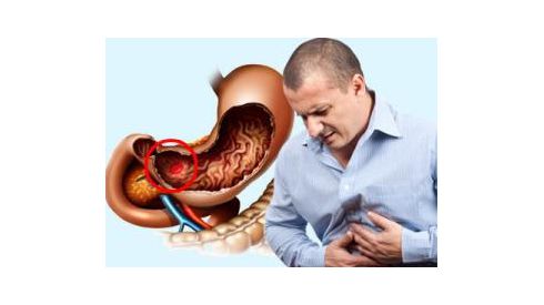 Эффективное противоязвенное средство