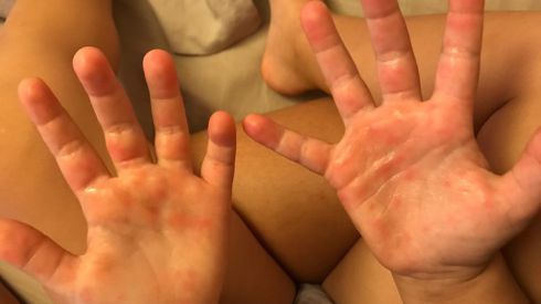 Симптомы вируса Коксаки и его лечение