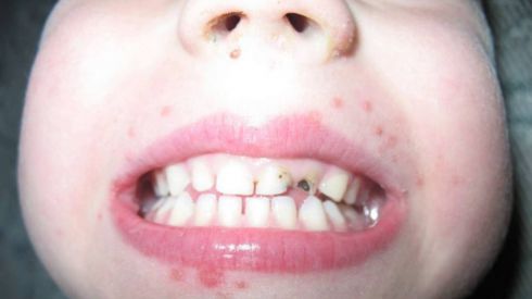 Вирус Коксаки – способ передачи, диагностика, симптомы и лечение у детей