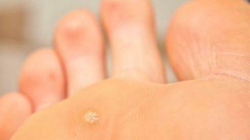 Бородавка: что это, почему возникает и в чём опасность