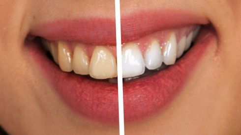 Избавляемся от зубного камня и налета при помощи доступного средства