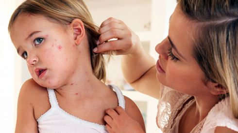 Почему в Украине вспыхнула корь? Отвечает врач-инфекционист