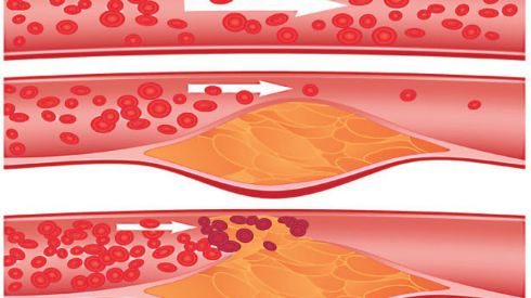 Что нужно знать об атеросклерозе?