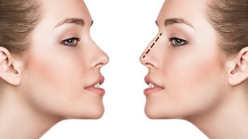 До 31 марта скидка 25% на операцию по изменению формы и размера носа