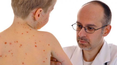 Корь не отступает: за неделю в Украине заболело 700 человек!