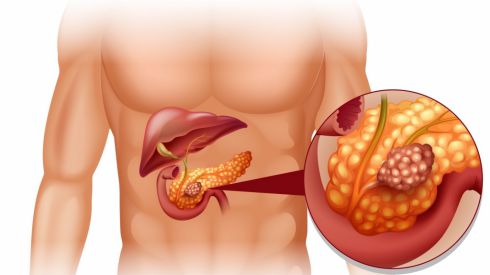 Как нужно питаться, если у Вас воспаление поджелудочной железы?