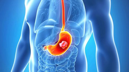 Язва желудка: все, что необходимо знать о «популярной» проблеме ЖКТ