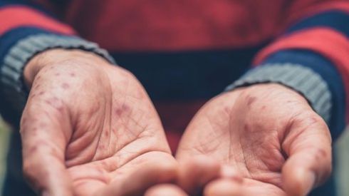 Во Львове от кори умер 3-летний мальчик