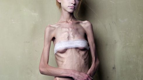 Кому грозит анорексия?