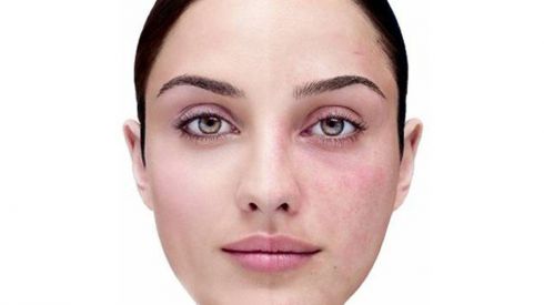 Демодекоз на лице — лечение лазером