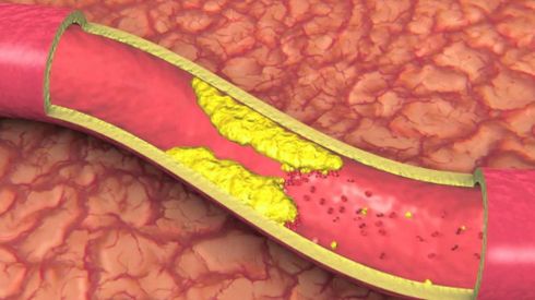 Чистка сосудов: самые эффективные продукты