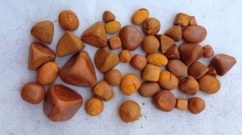 Камни в желчном: симптомы