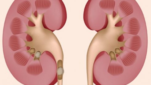 Продукты, которые вызывают камни в почках