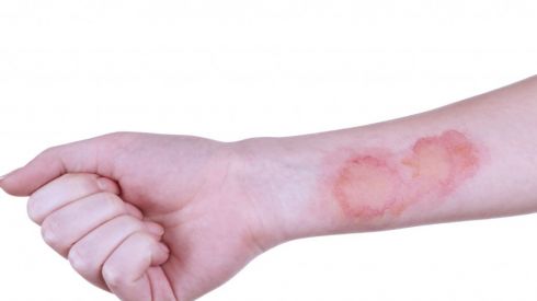 Что делать при разных ожогах