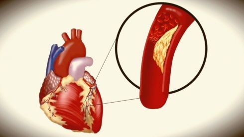 Почему отрывается тромб?
