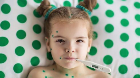 Что нужно знать о ветрянке