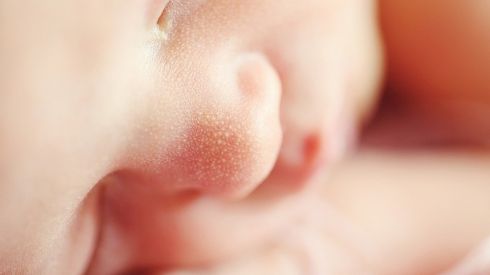 Сыпь у новорожденных (ФОТО)