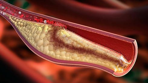 Аневризма аорты: причины, симптомы, лечение и профилактика