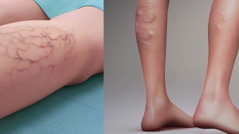 10 фактов о варикозе