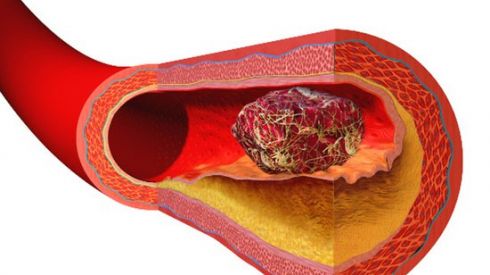 9 опасных признаков тромбоза