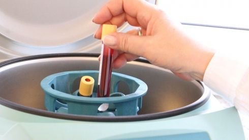 Почему после 50 лет повышается уровень холестерина