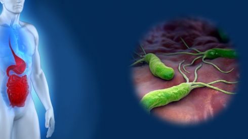 Нужно ли лечить хеликобактер пилори