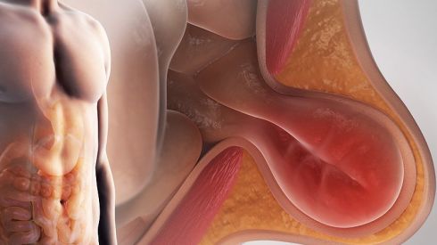 Паховая грыжа: причины и способы лечения