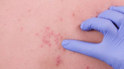 Как отличить корь от ветрянки, краснухи и других заболеваний
