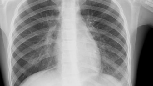 Воспаление легких: причины, симптомы, лечение