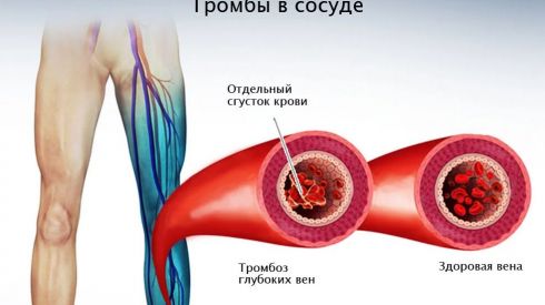 Кому грозят тромбы