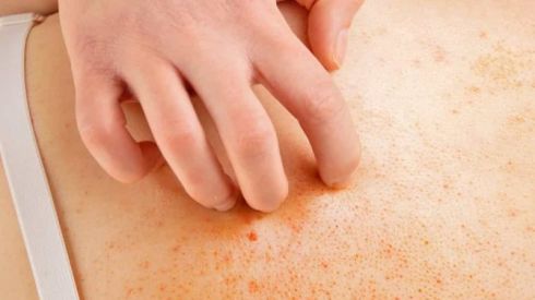 7 видов сыпи при коронавирусе (ФОТО)