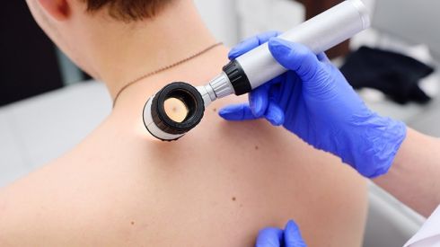 Прийом лікаря-онкодерматолога: перевірте родимки