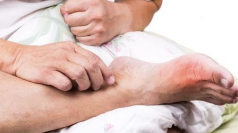 Можно ли вылечить подагру? Мнение врачей